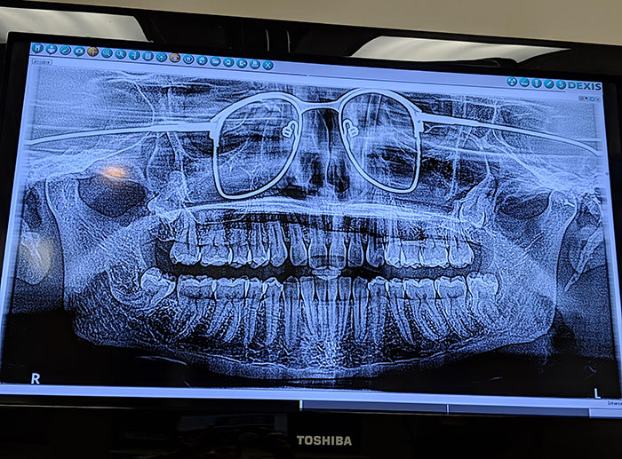 I Got A Panoramic X-Ray Of My Teeth The Other Day. The Dentist Forgot To Have Me Remove My Glasses