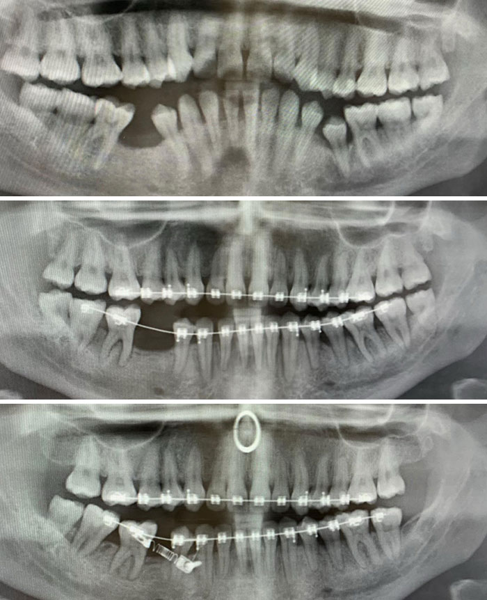 My X-Rays Before Braces In August 2018 To Now August 2020