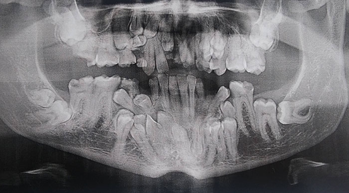 I Have A Rare Disorder Called Cleidocranial Dysotosis. Got My First Dental X-Ray Today And I Have A Lot Of Extra Teeth