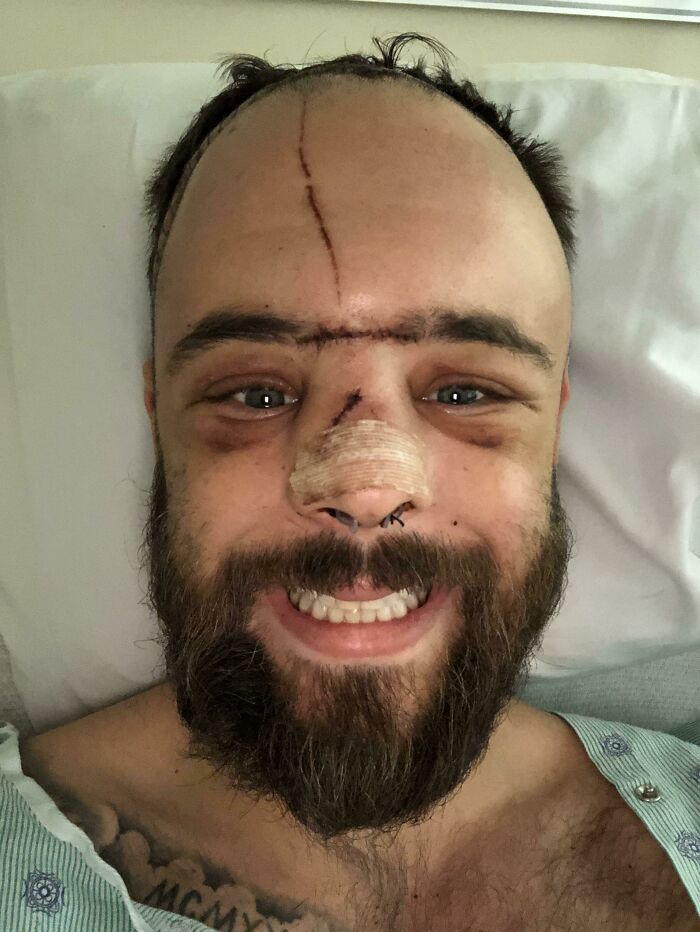 I Survived A 2x4 Pallet Slingshot To The Face. 2 Facial Reconstructions And A Brain Surgery Later. I’m Alive And I Have A Chance To Help People For The Rest Of My Life Experience