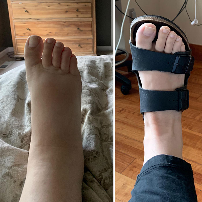 My Ankle Two Days Before Giving Birth (Left) And My Ankle Two Days After Giving Birth (Right)