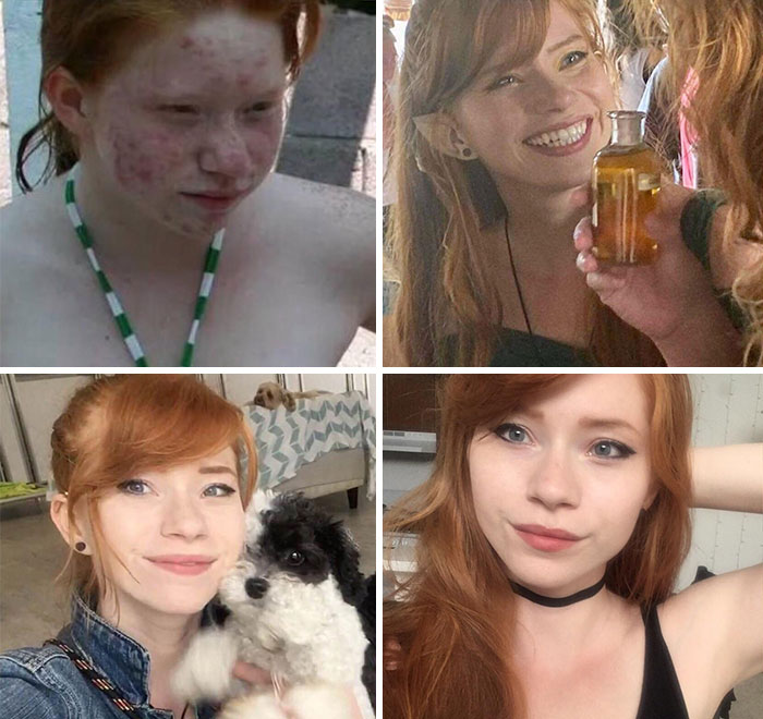 From About 11ish(?) To 25. My Skin Cleared Up, I Got Braces, Learned How To Make Up And Fill In My Eyebrows. I Was Made Fun Of/Very Lonely Growing Up, And I Feel The Way That I Looked Had A Big Impact On Why I Am The Way That I Am Now. “Be Kind”