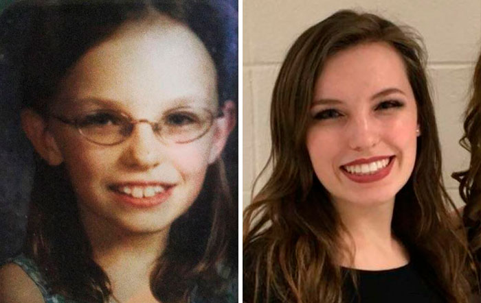 Age ~11 To 20 - I Owe A Lot To Contacts, Braces, Filling In My Eyebrows, And My Hairline Somehow Growing Forward