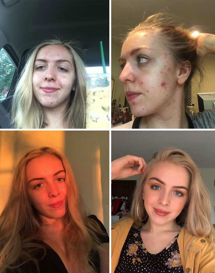 19 To 20. I Would Like To Thank My Dermatologist