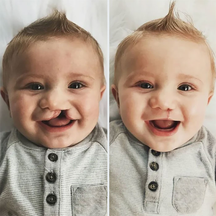 Cleft Lip And Cleft Palate, Two Week Surgery