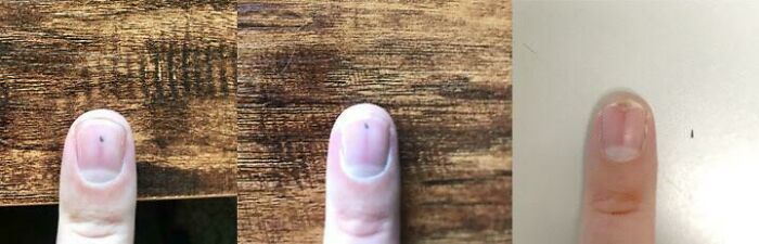 The Thorn That’s Been Traveling Through My Fingernail Since July 18 Completed Its Journey In October