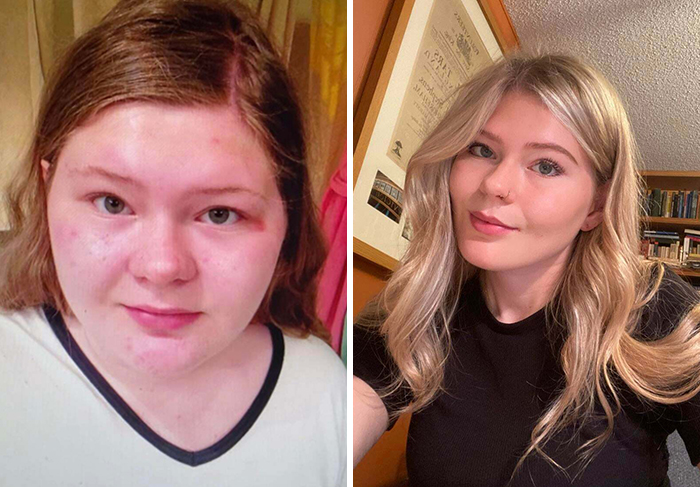 15 - 19 I’d Like To Thank Accutane And Losing 90lbs
