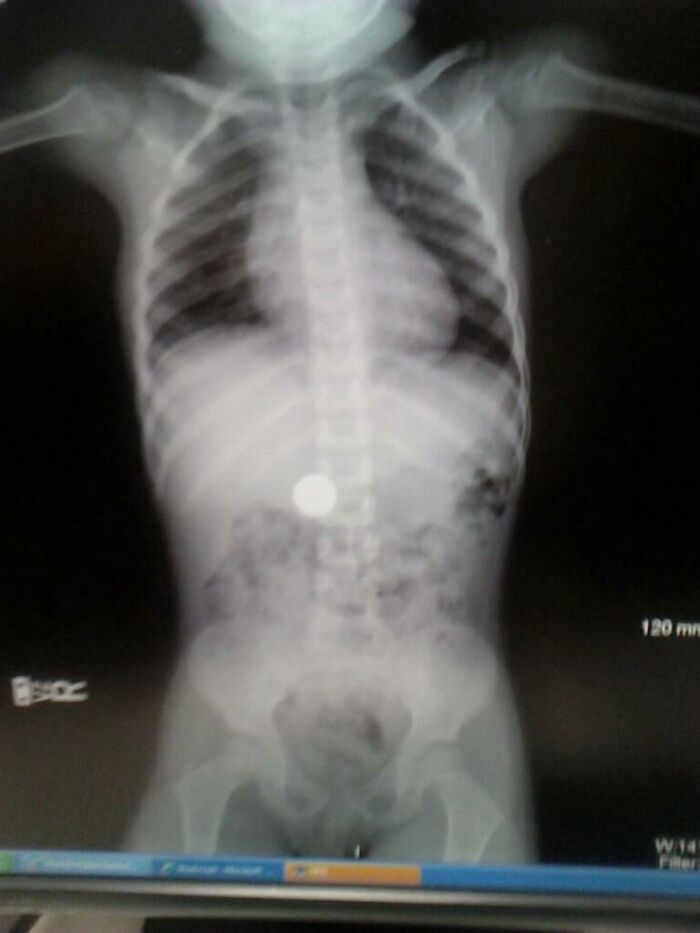 This Is My X-Ray After I Ate A Quarter After Stealing It From My Brother When I Was 5