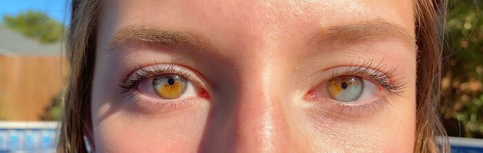  Tengo heterocromía parcial en ambos ojos