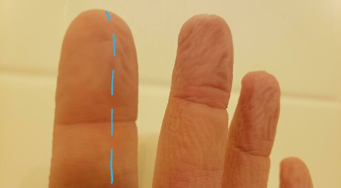 Severed A Nerve In My Index Finger. Half My Finger Can No Longer Prune
