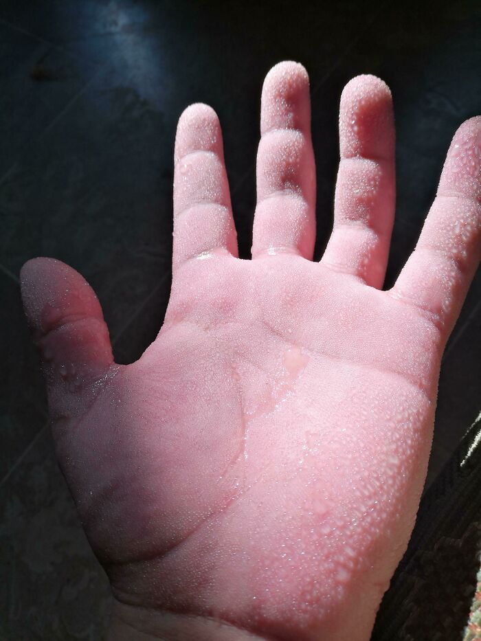 I Have Hyperhidrosis, Which Means My Hands And Feet Sweat A Lot. This Is How My Hands Usually Look