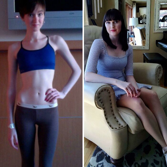 I Recovered From An 8 Year Battle With Anorexia And Am The Happiest And Healthiest I’ve Ever Been
