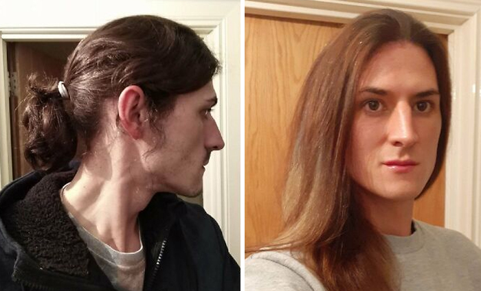 The Difference A Year Can Make, I've Fought Anorexia For Years And Decided To Grow Out My Hair Because I Began To Lose It Due To Years Of Disordered Eating, Its Just Over 2 Years Growth Currently And I Have Full Health Hair Again, Big Up To Recovery. Much Love To Anyone Else Who Might Be Struggling