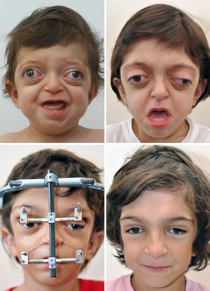 Plastic Correction In A Boy With Crouzon's Syndrome. He Even Showed Improvement In Vision And Breathing