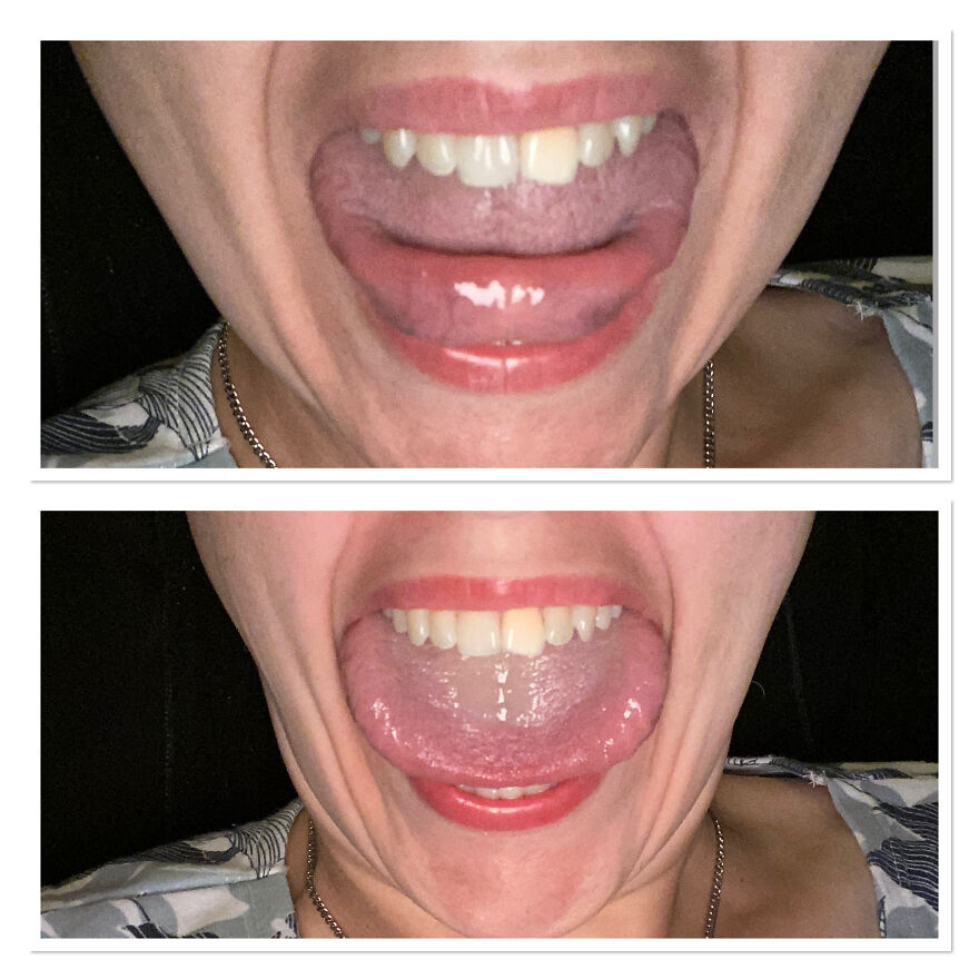 Top Photo Is My Tongue Touching My Tongue And The Bottom Photo Is Showing How Wide My Tongue Is.