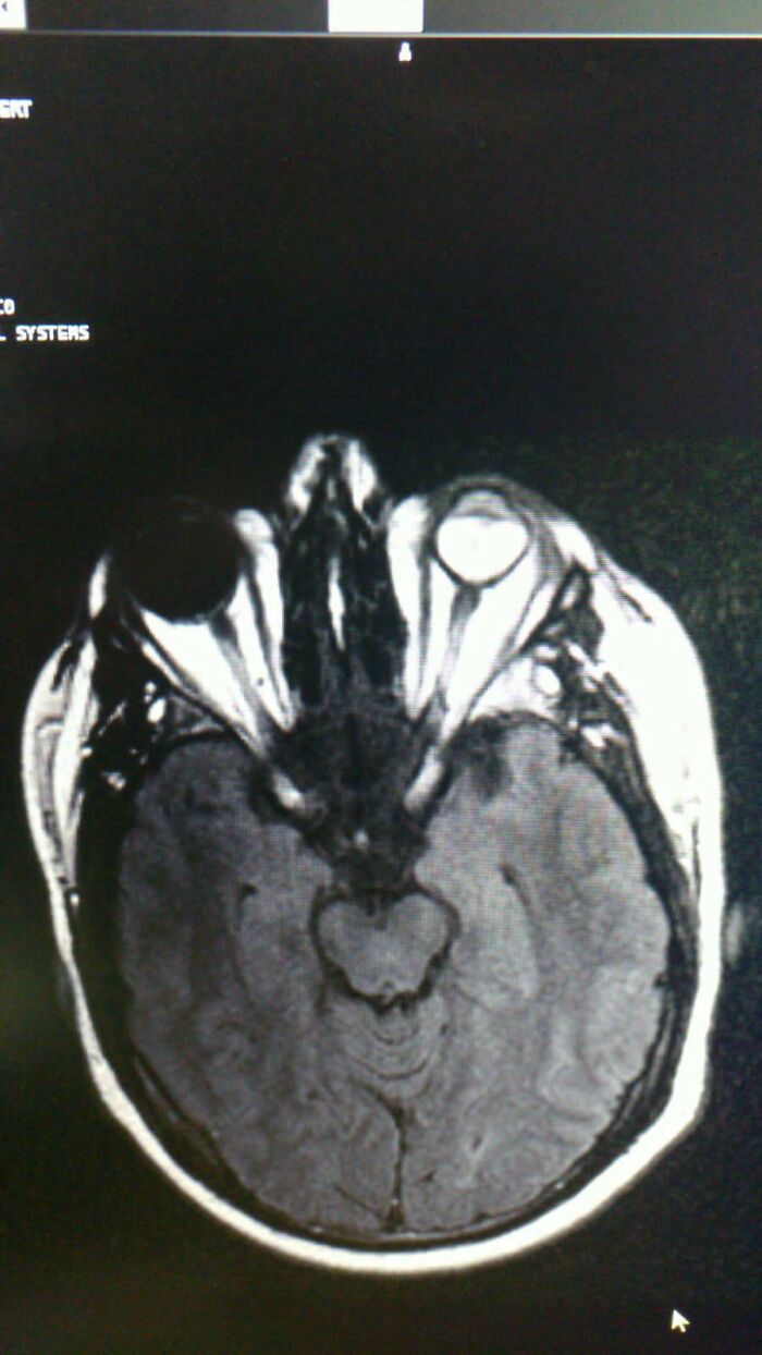 My Husband’s Mri Scan Shows His Blind Left Eye As Fully Black