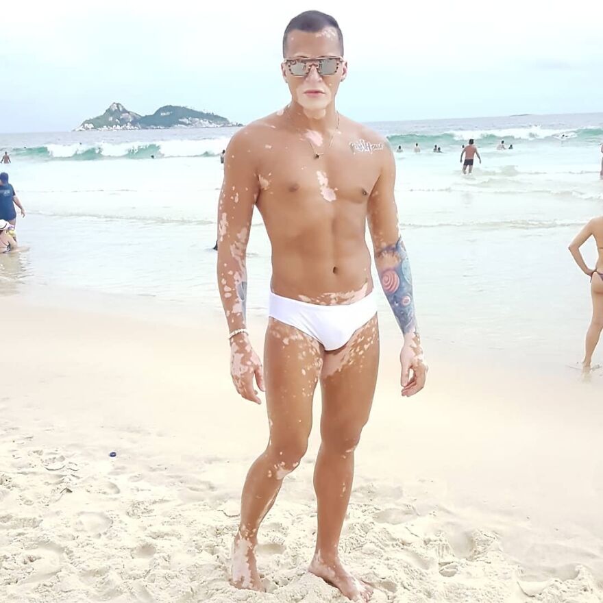 After Battling Depression For A Decade, This Brazilian Model With Vitiligo Learnt To Accept Himself