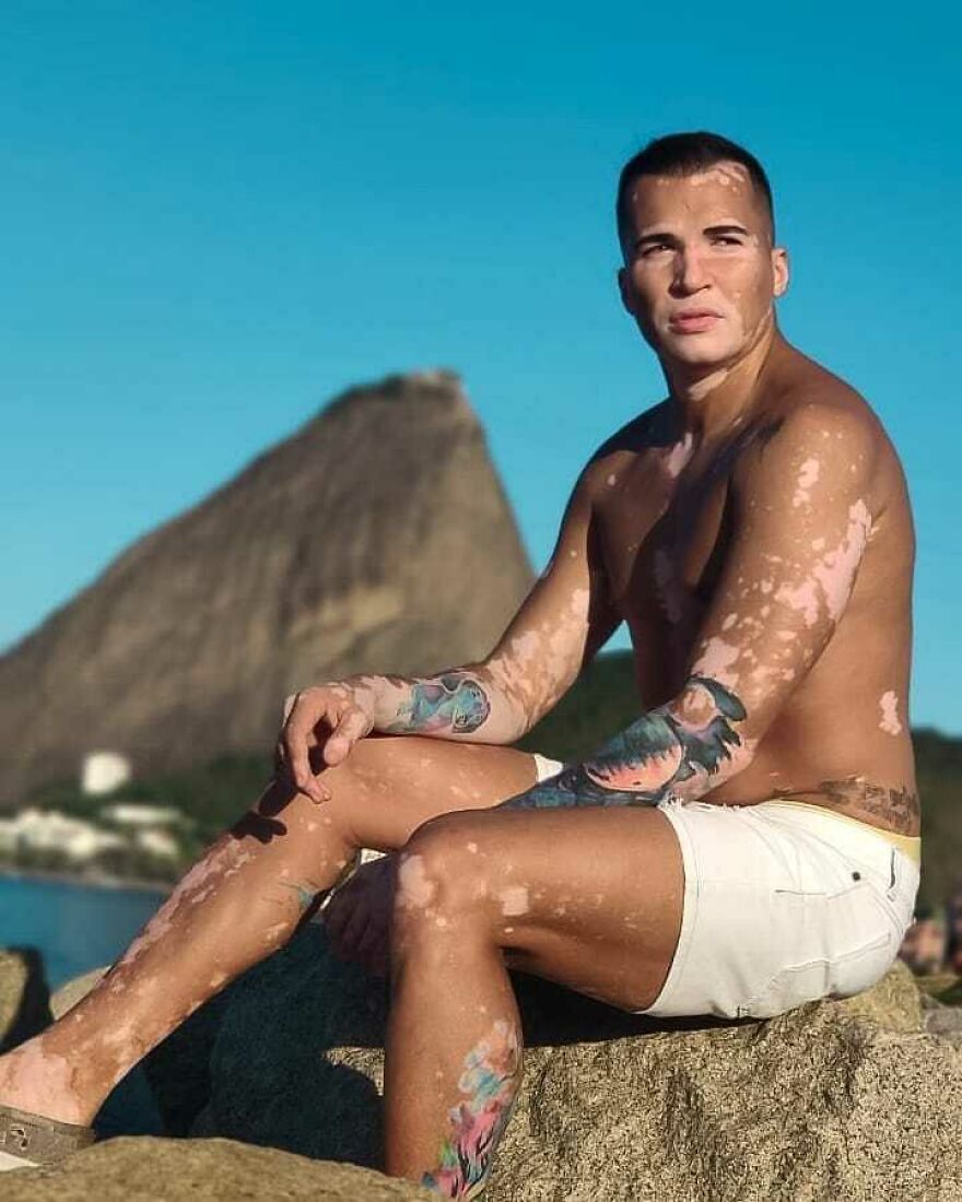 After Battling Depression For A Decade, This Brazilian Model With Vitiligo Learnt To Accept Himself