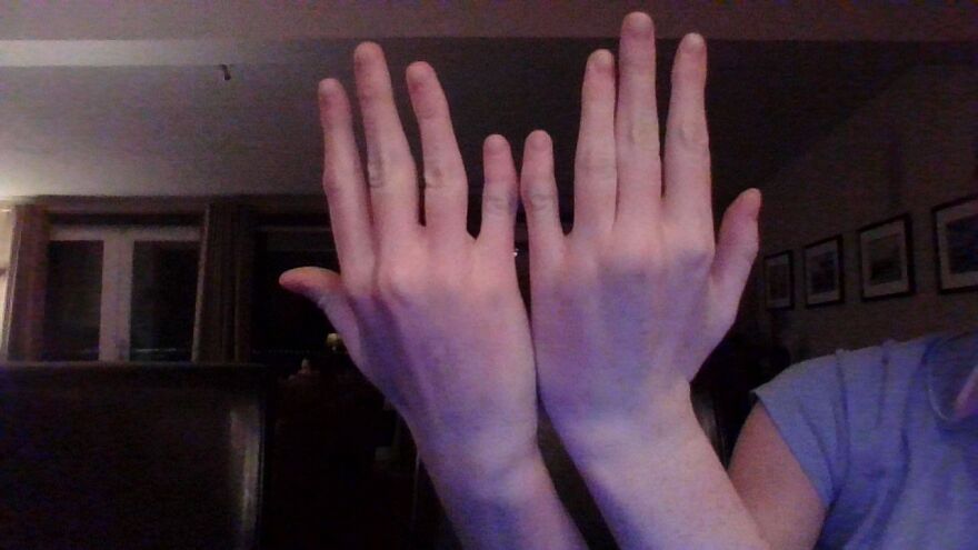 Clinodactyly, When Someone Is Borne With Bent Pinkies. They Are Also Half The Size Of A Normal Persons