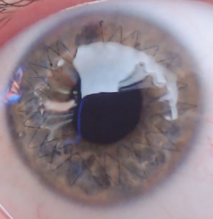 The Stitches In My Eye After My Cornea Transplant