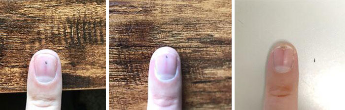 The Thorn That’s Been Traveling Through My Fingernail Since July 18 Completed Its Journey Today