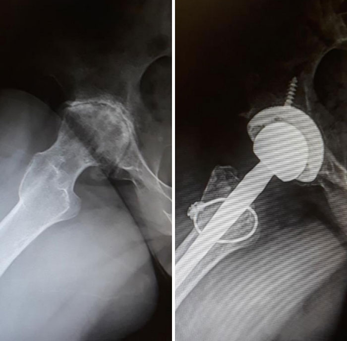 Before And After Hip Replacement Surgery