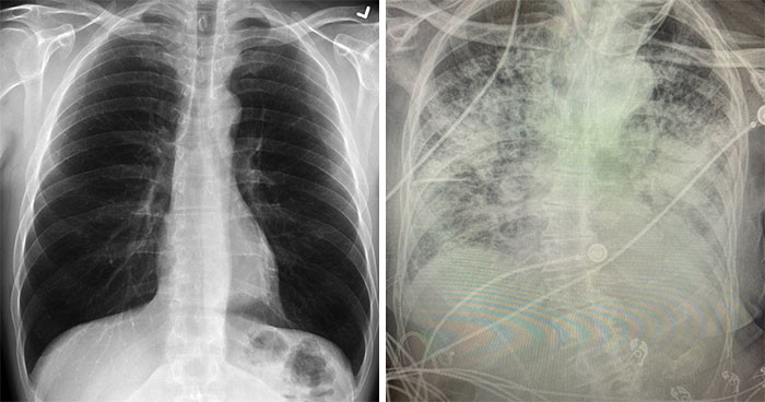 X-Ray Shows The Effect Of COVID-19 On The Lungs Compared To A Smoker’s Lungs
