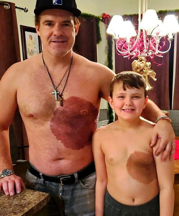 This Dad Got A Tattoo To Match His Son's Birthmark To Boost His Self Esteem