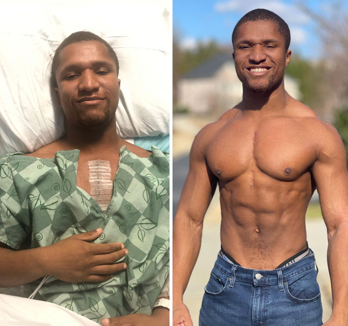 I Beat Heart Surgery! My Surgery Was December 2019. I Was Bed Bound For A Week, Followed By Another 4 Months Of Not Working Out At All