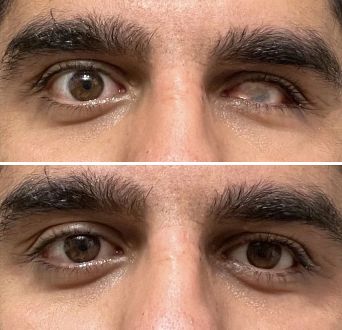 Antes y después de ponerme mi ojo falso