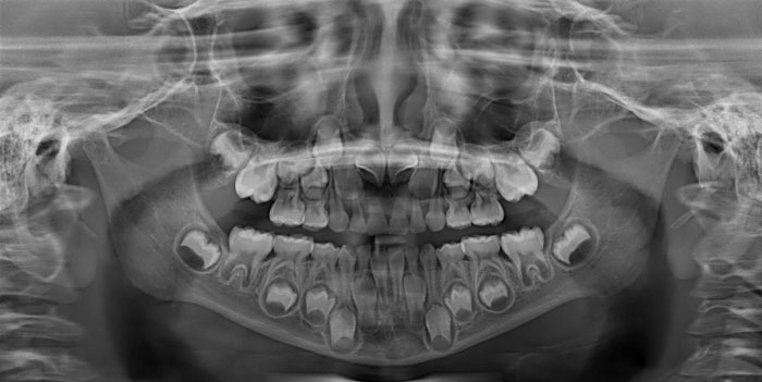 X-Rays Of Children's' Mouths Between The Ages Of 6-12 Years Still Hold Wonder For Me, Even After Being A Dentist For 10+ Years