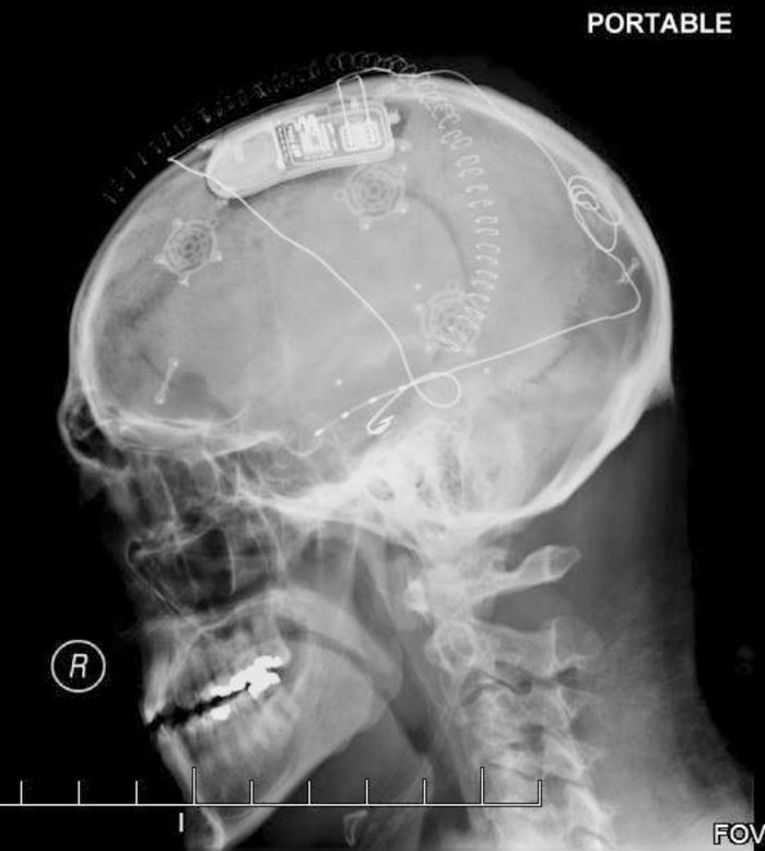 A Nice Clear X-Ray Showing My RNS Device, The Leads That Run To The Point Where My Seizures Originate