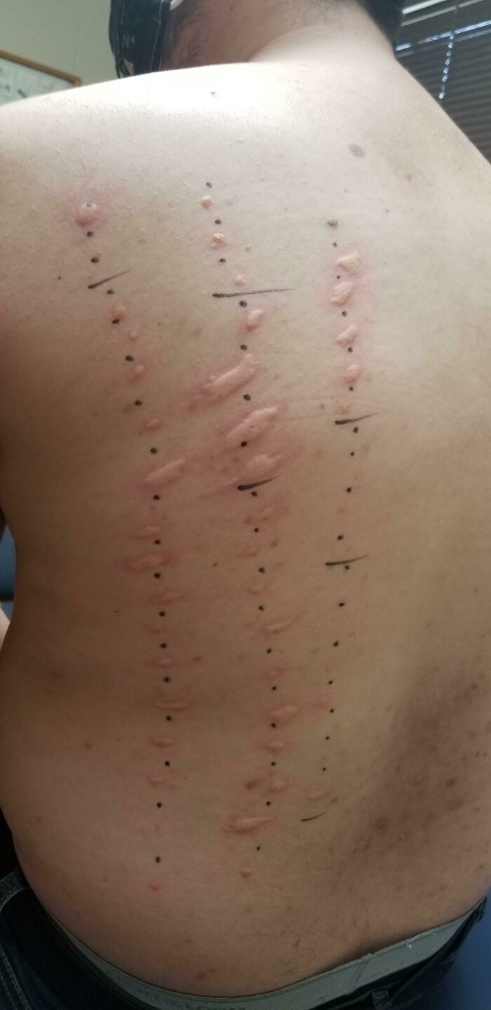The Results Of My Allergy Test Today. I Am Allergic To Everything They Tested For.