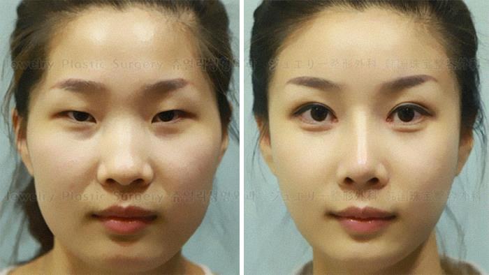 Til Many Chinese Medical Tourists Who Go To South Korea For Inexpensive And High Quality Plastic Surgery Have Difficulty Re-Entering China Due To Their Passports Photos Not Matching Their New Face Post Op.
