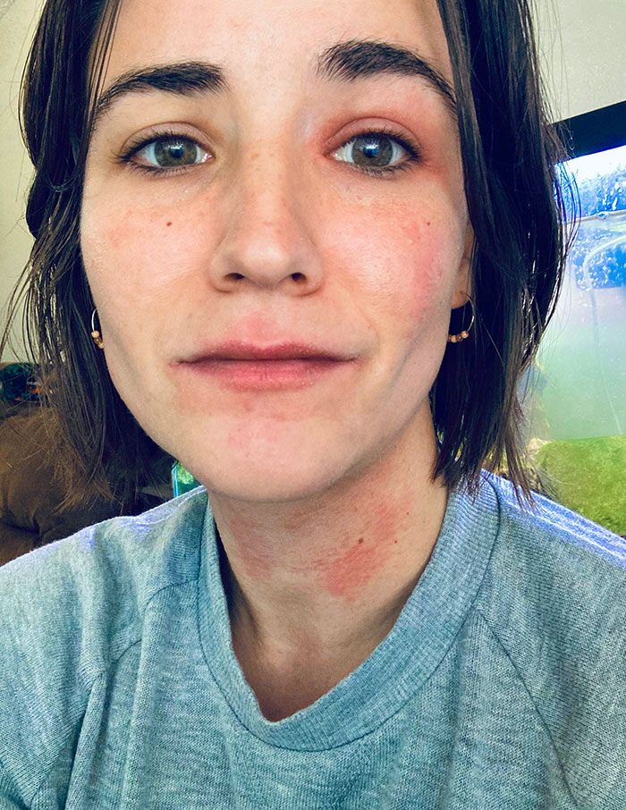 My Toddler Daughter Rode On My Shoulders And Touched My Face During Our Last Hike, Grabbing Random Leaves As We Went Along. I’m Highly Allergic To Poison Ivy