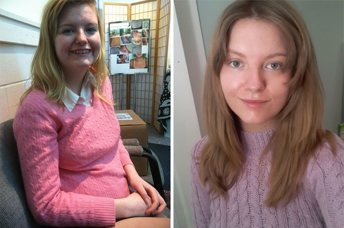 Still Working On Myself, But Time And Hygiene Can Do Wonders! I Was Wearing Makeup In The First Pic, And Not The Second. [15/2012 - 24/2021]