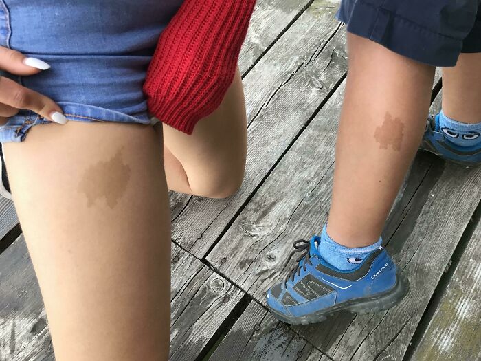 My GF And My Nephew Have A Very Similar Birthmark Despite They Aren’t Related At All