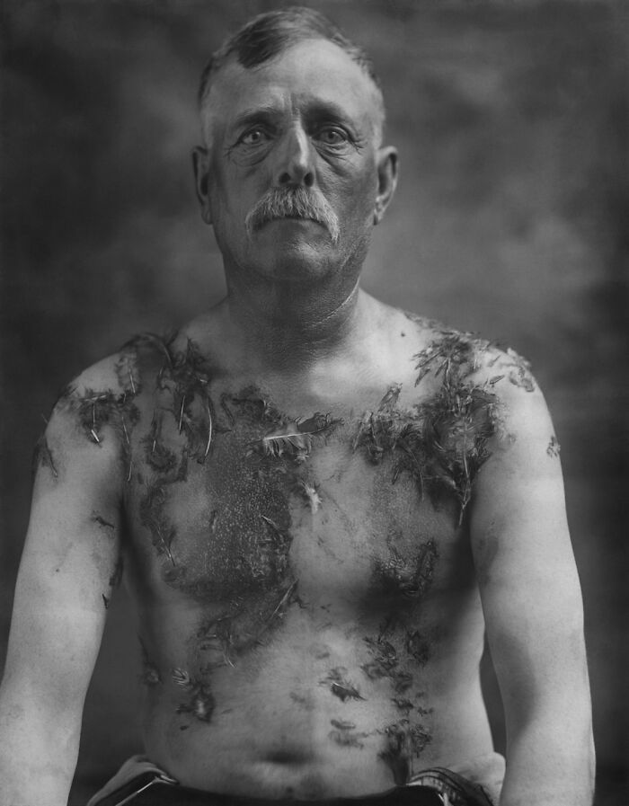 John Meintz, An American Farmer Tarred And Feathered By A Mob For His German Heritage And Allegedly Not Supporting War Bond Drives, 1918
