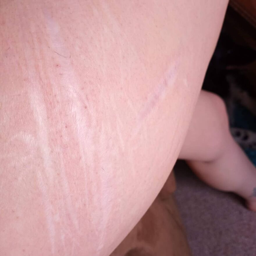 I Interview People About Their Scars I Interview People About Their Scars