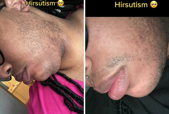 A TikToker Shares Her Experience With Hirsutism In Hopes Of Raising Awareness And Educating People On The Condition