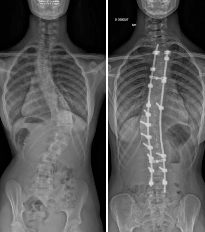 Hoy hace 6 años me operaron para enderezar mi columna vertebral, este es el resultado del antes y el después. Aumenté 5cm con el proceso