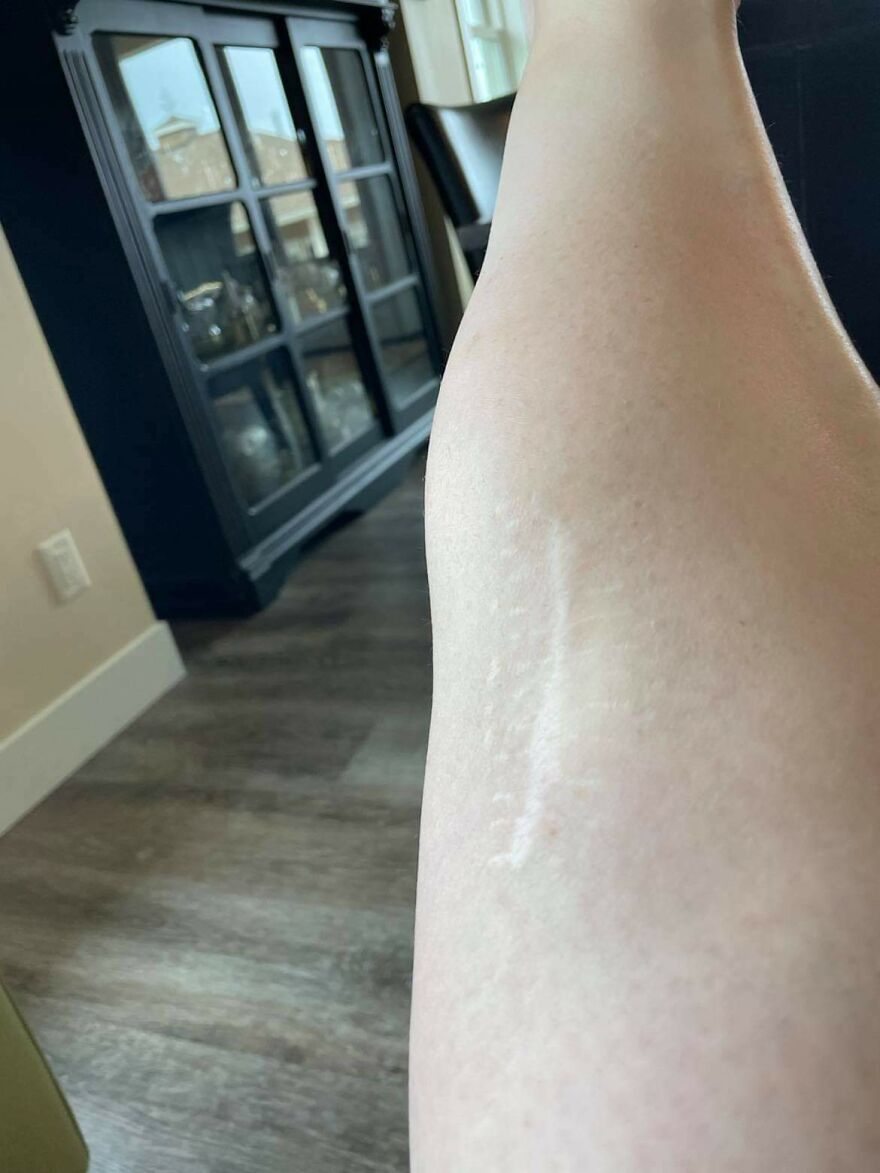 I Interview People About Their Scars I Interview People About Their Scars