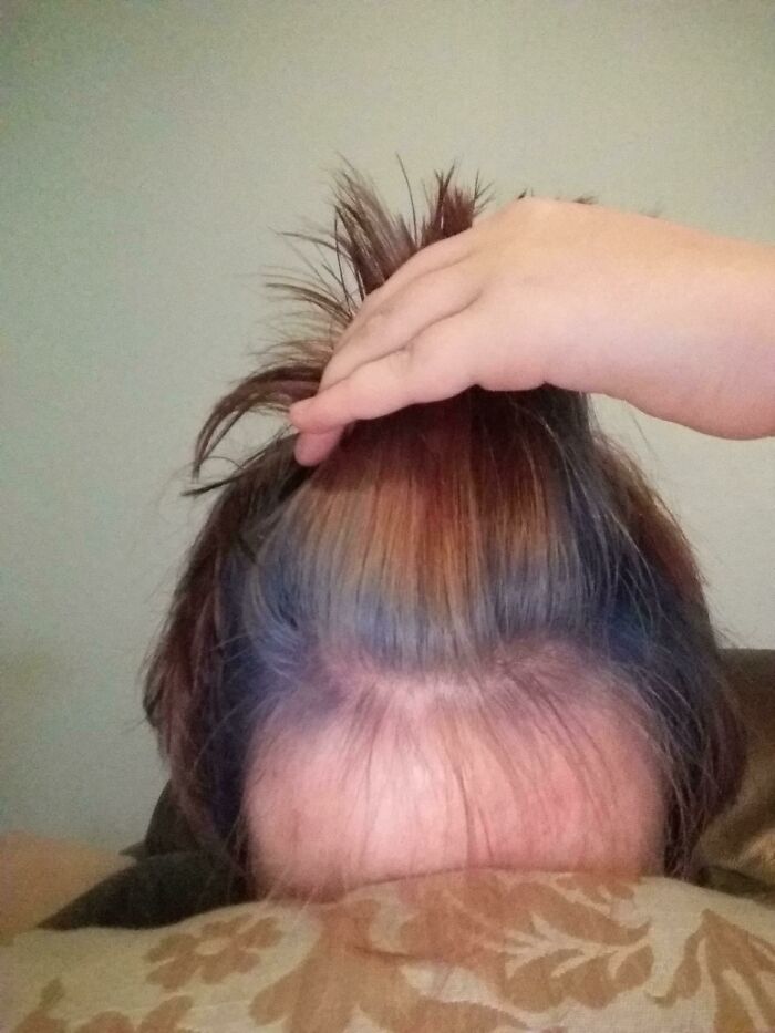 Tried Bleaching My Hair To Get Rid Of The Red So I Could Go Deep Blue. The Bleach Only Got Rid Of The Color On My Roots The Rest Went Pink. I Dyed It Anyway 