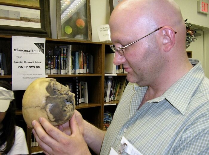 The Mysterious 'Starchild Skull' Came From A Human With Congenital Hydrocephalus
