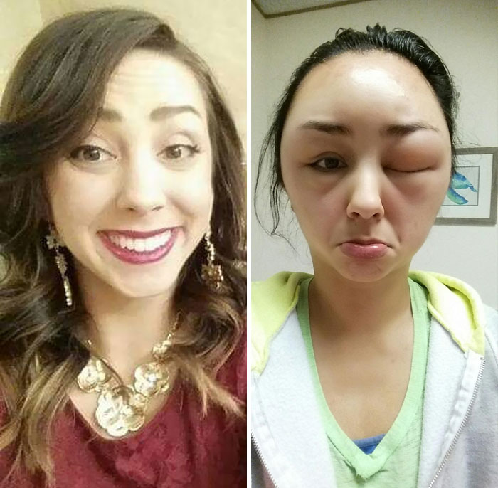 So, My Friend Had A Pretty Ridiculous Allergic Reaction To Hair Dye. Pic On The Left Is What She Normally Looks Like