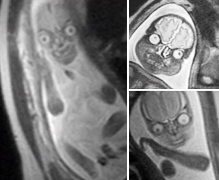 Una resonancia magnética de bebés durante el embarazo