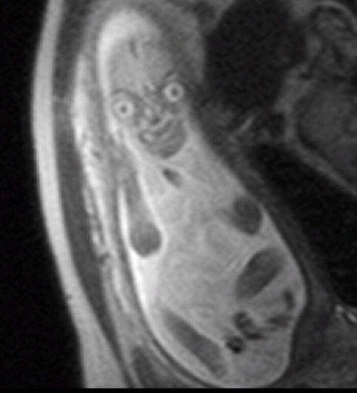 Bebé en el estómago durante una resonancia magnética