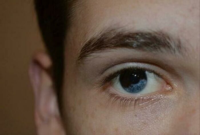 I Was Born With Sectoral Heterochromia, Although It’s Rare