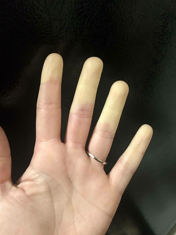 Loss Of Blood Flow To My Fingers Due To Raynaud’s Disease
