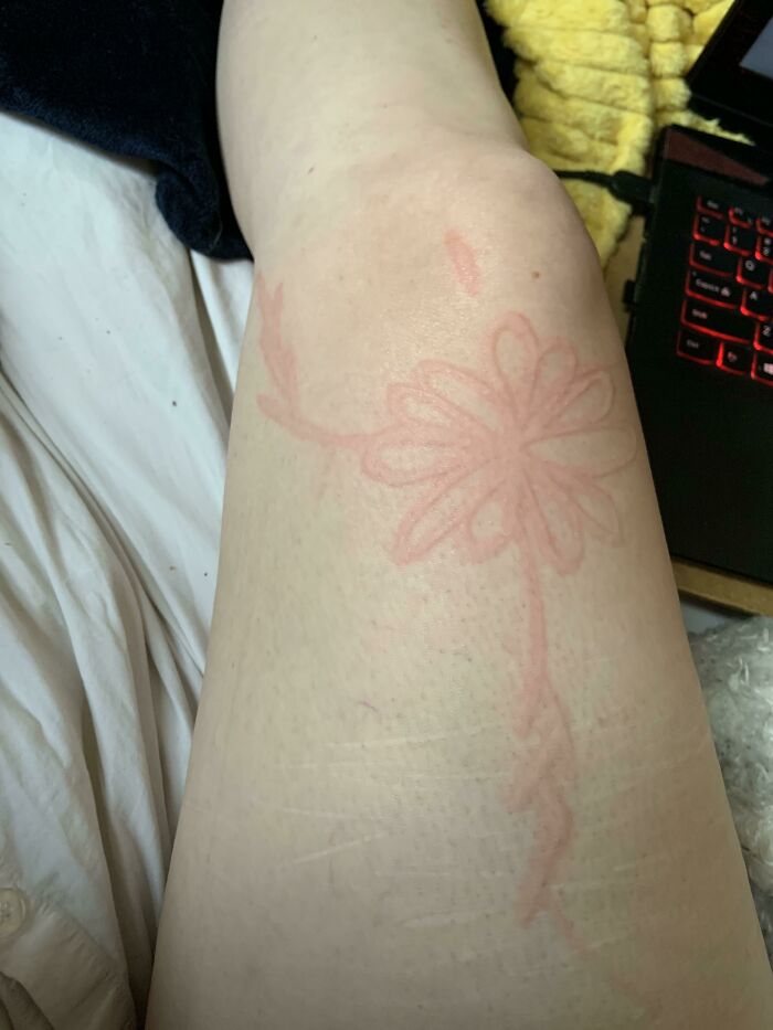I Have A Skin Condition Called Dermatographia Which Causes My Skin To Raise From The Smallest Scratch And I Like To Draw Flowers On Myself Sometimes